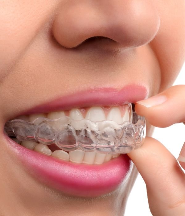 Orthodontics and Clear Aligners